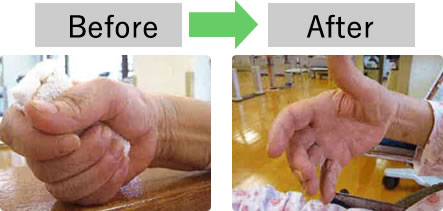 脳卒中の後遺症による手足のつっぱり（痙縮）改善の様子